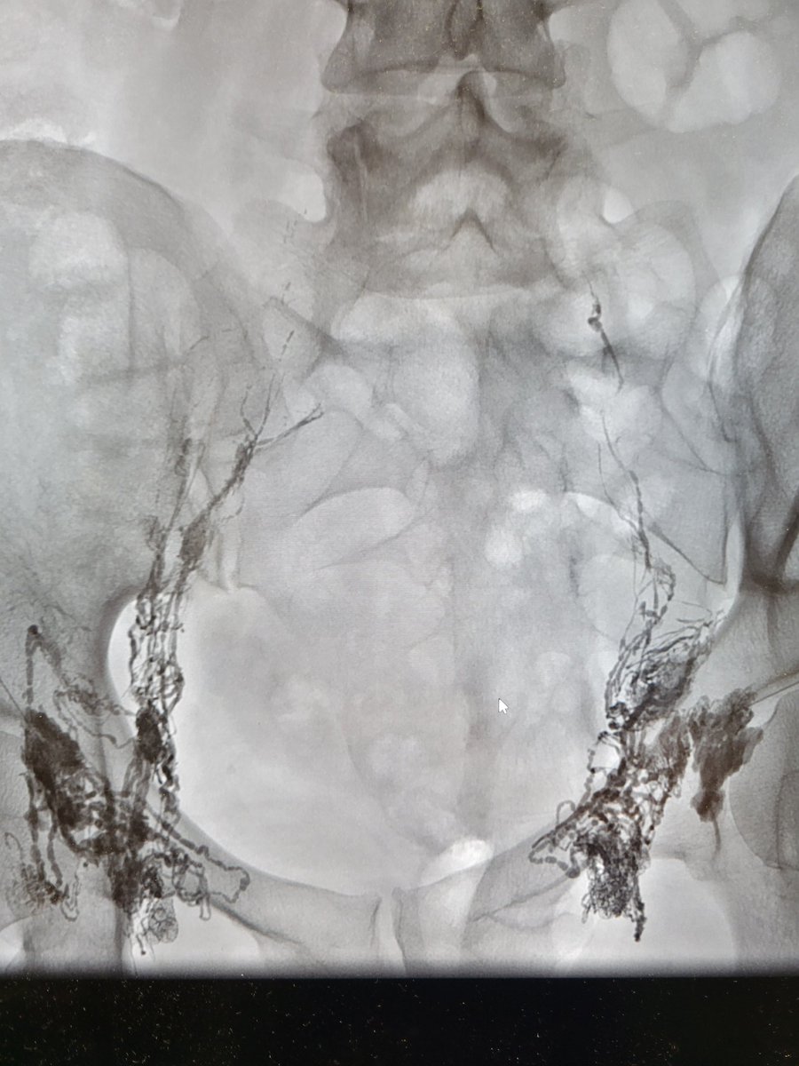 TempleRADs's tweet photo. Patient with thyroidectomy and neck chyle leak. Lymphangiogram and thoracic duct embolization performed. Leak resolved. Cannulating that thoracic duct is no easy task. Fantastic work @joepanaro @MarkEdelsteinIR! @TempleRadRes @SIR_ECS @SIRRFS #IRAD https://t.co/DlfZICTFmY