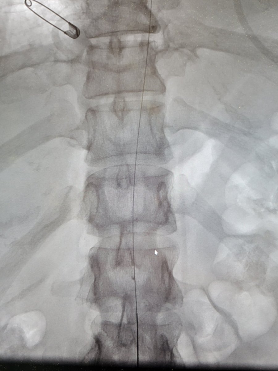 TempleRADs's tweet photo. Patient with thyroidectomy and neck chyle leak. Lymphangiogram and thoracic duct embolization performed. Leak resolved. Cannulating that thoracic duct is no easy task. Fantastic work @joepanaro @MarkEdelsteinIR! @TempleRadRes @SIR_ECS @SIRRFS #IRAD https://t.co/DlfZICTFmY