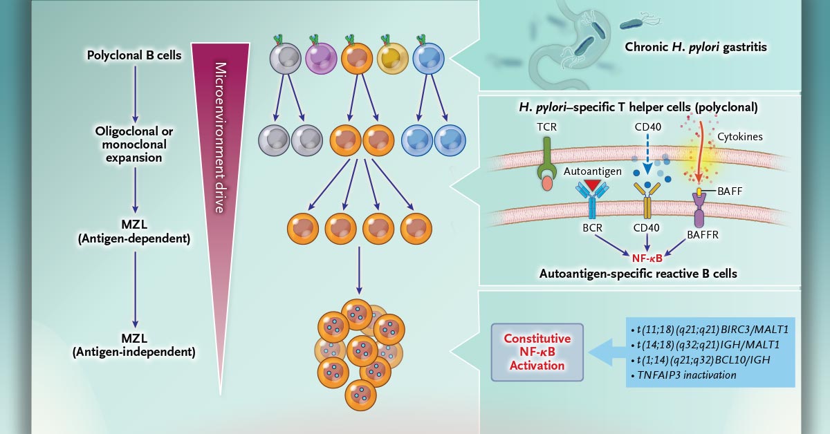 NEJM's tweet photo. In a new review, the classification, epidemiology, pathogenesis, clinical presentation, and management of marginal-zone lymphomas are covered, with discussion specifically tailored to increase awareness across medical disciplines. https://t.co/4iSBE7iHQG https://t.co/THmfxaLqdE