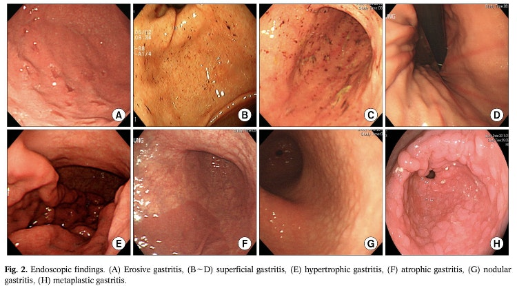 EndoCollabcom's tweet photo. Endoscopic Diagnosis of Gastritis is Difficult 

A Thread 🧵 https://t.co/UJFDWTFp6T