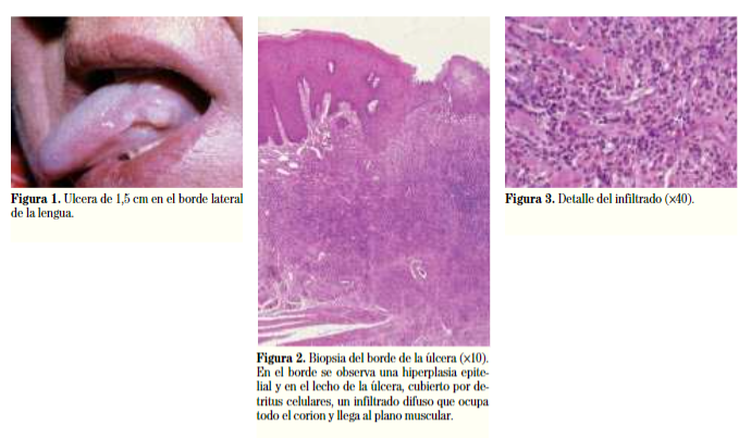 Elsevier_Es's tweet photo. #CasosClínicos #RevistasElsevier Dermatología

Lesión ulcerada en la lengua 👉 https://t.co/gxcrIP3N7i https://t.co/uKuwAjJru5