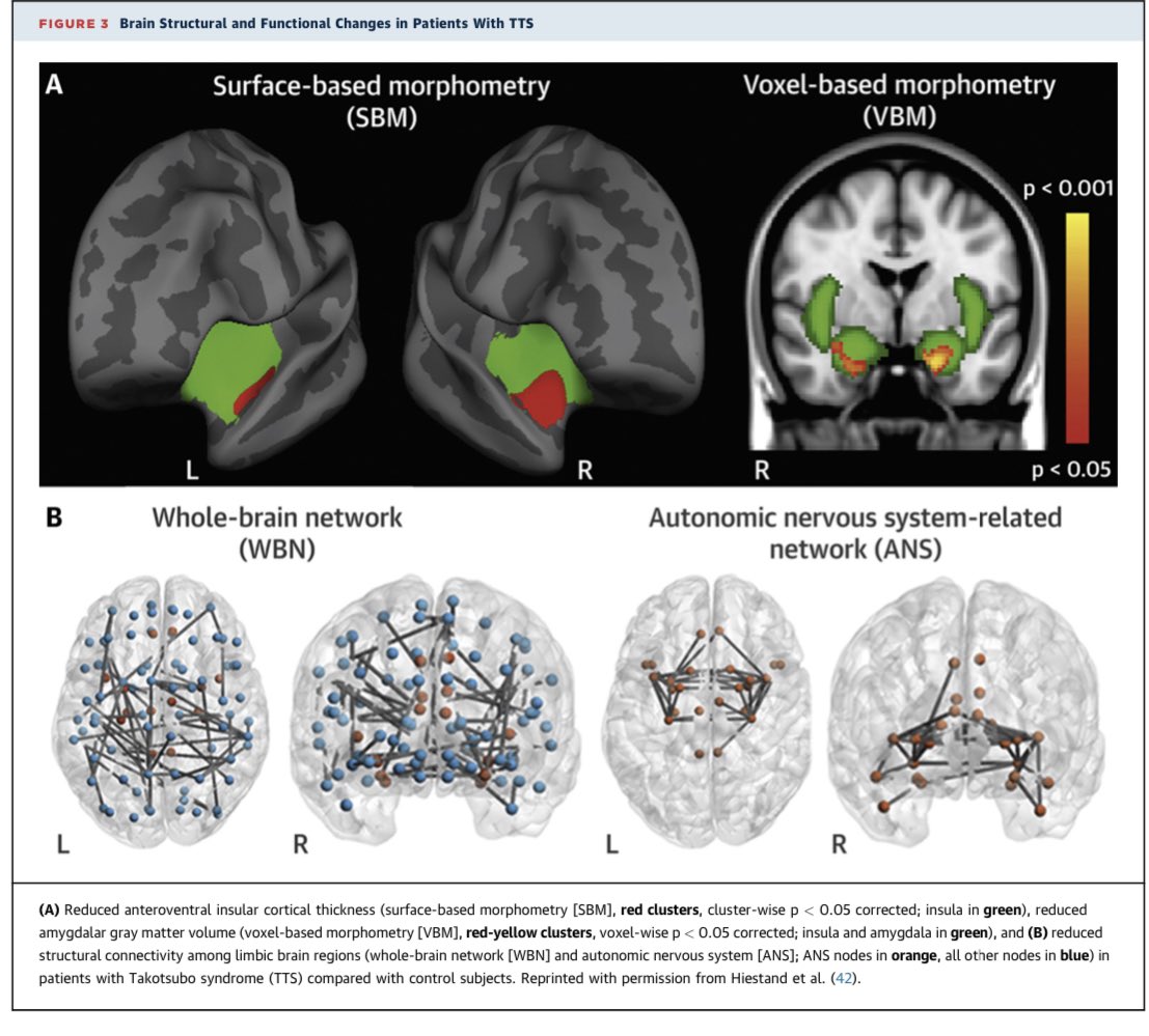 🚨🚨Sx de takotsubo
✅Mecanismos implicados en la disfunción miocardica 
✅ Cambios funcionales y estructurales en el cerebro 
✅ Ejemplos  primarios y secundarios en las causas de takotsubo 
✅ Respuestas miocárdicas a niveles elevados de epinefrina