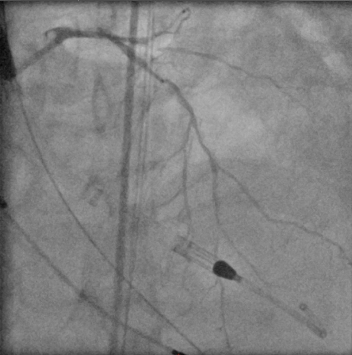 AndWierucki's tweet image. 55 y.o. Pat. with NSTEMI, VT 🌩 3CVD, CTO LCX (2018) — Protected PCI with #Impella #singleaccess #rotapro #scoringballoon #dcb #safefemoral @AGIKinterv @KPujdak @kaschenke @KardiologieHH @klinki_hh @Obisht @HolgerNef @MarcVorpahl
