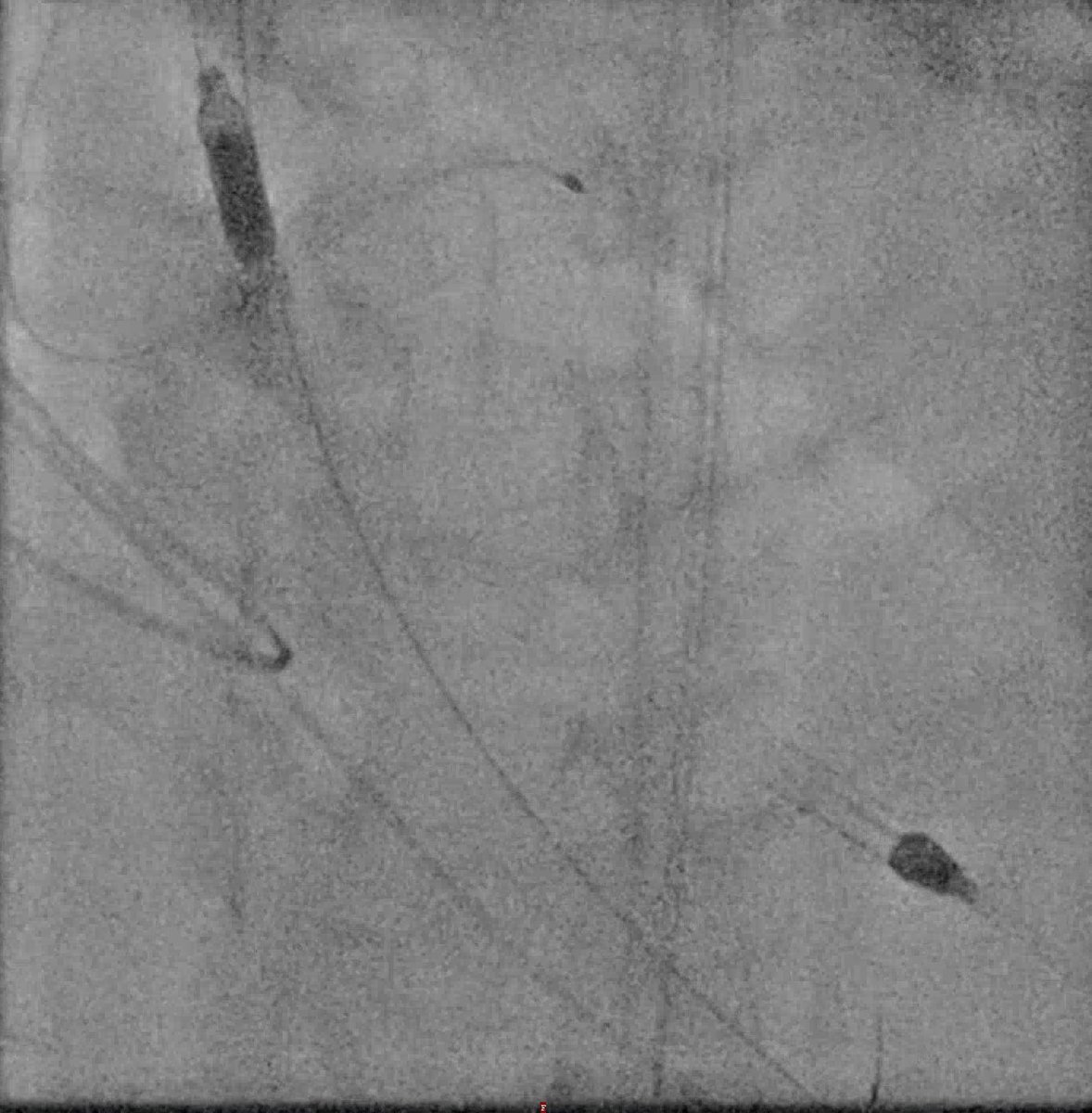 AndWierucki's tweet image. 55 y.o. Pat. with NSTEMI, VT 🌩 3CVD, CTO LCX (2018) — Protected PCI with #Impella #singleaccess #rotapro #scoringballoon #dcb #safefemoral @AGIKinterv @KPujdak @kaschenke @KardiologieHH @klinki_hh @Obisht @HolgerNef @MarcVorpahl