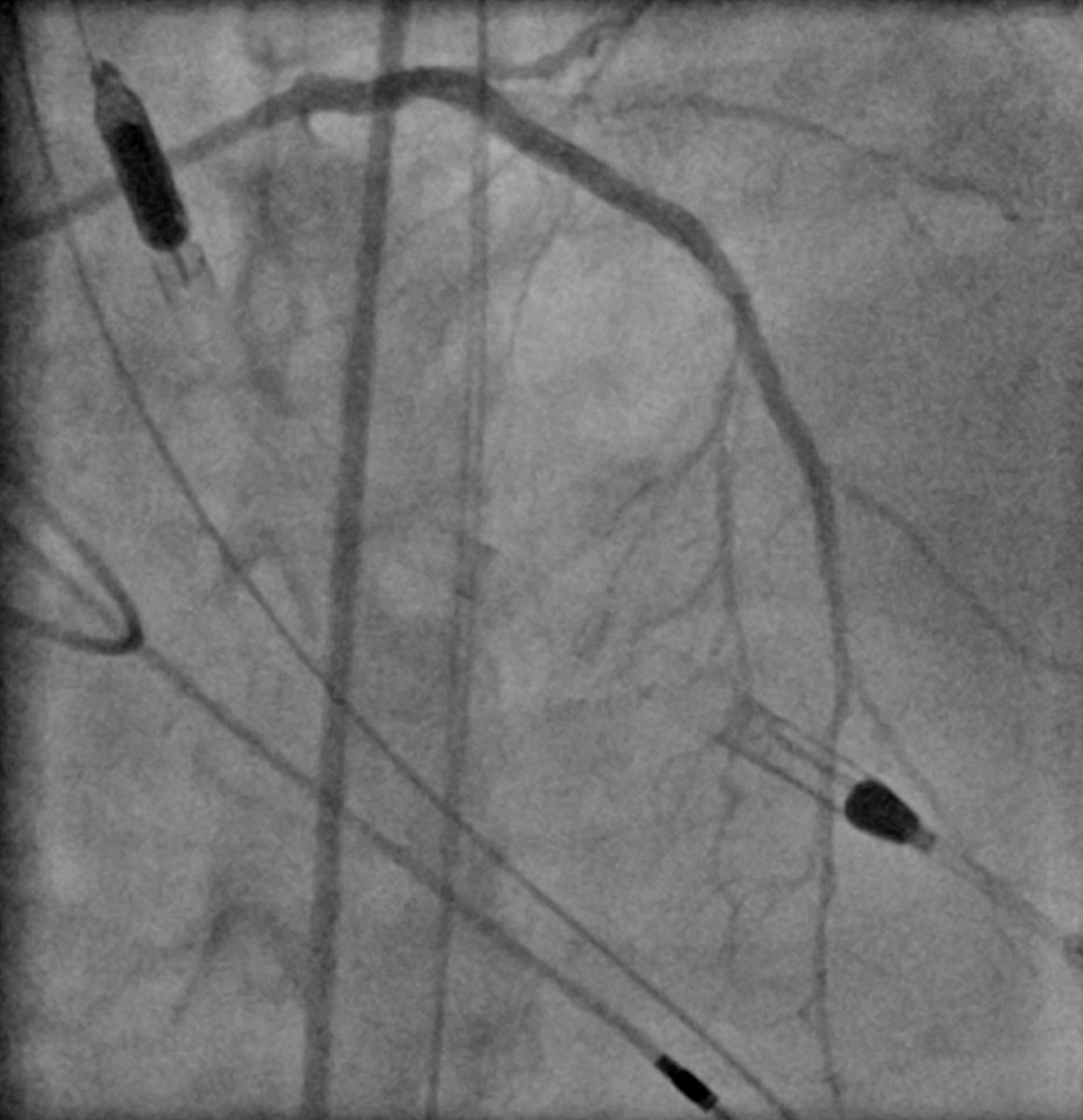 AndWierucki's tweet image. 55 y.o. Pat. with NSTEMI, VT 🌩 3CVD, CTO LCX (2018) — Protected PCI with #Impella #singleaccess #rotapro #scoringballoon #dcb #safefemoral @AGIKinterv @KPujdak @kaschenke @KardiologieHH @klinki_hh @Obisht @HolgerNef @MarcVorpahl