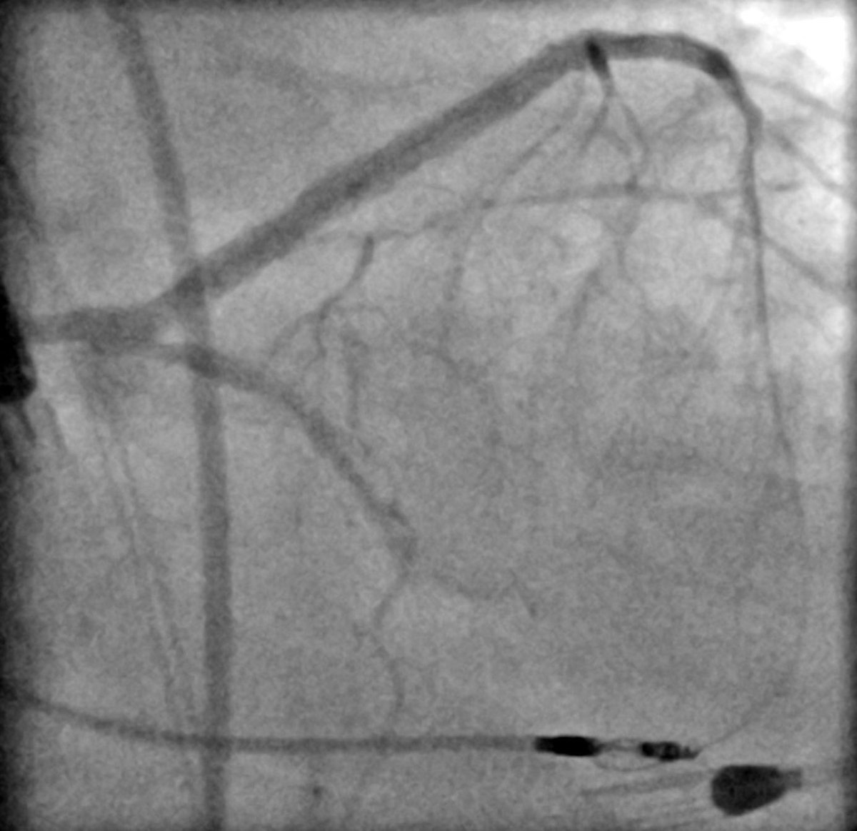 AndWierucki's tweet image. 55 y.o. Pat. with NSTEMI, VT 🌩 3CVD, CTO LCX (2018) — Protected PCI with #Impella #singleaccess #rotapro #scoringballoon #dcb #safefemoral @AGIKinterv @KPujdak @kaschenke @KardiologieHH @klinki_hh @Obisht @HolgerNef @MarcVorpahl