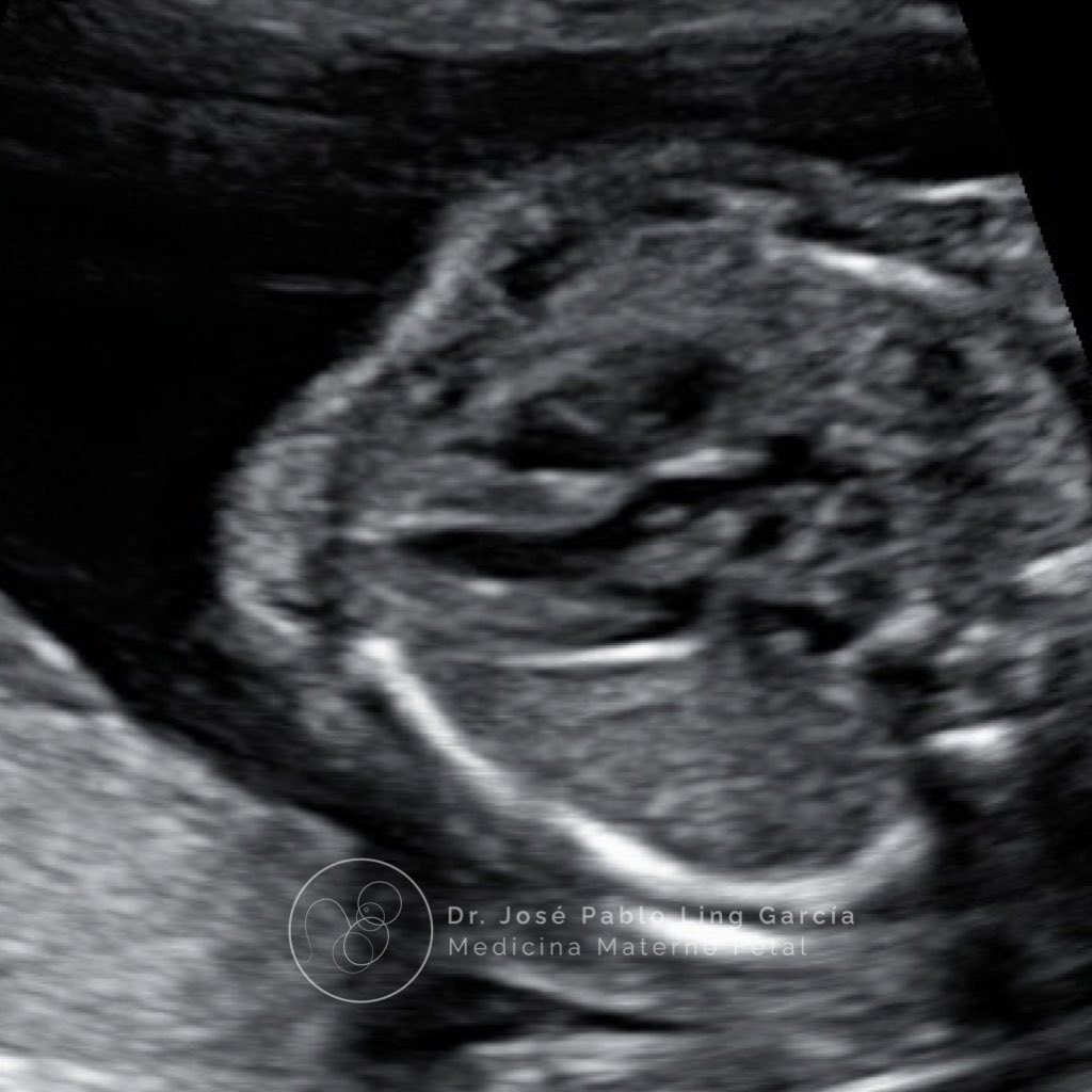 Drpabloling's tweet photo. Corazón fetal. Tracto de salida del ventrículo izquierdo.🫀

#corazon #feto #embarazo #ultrasonido #maternidad #tbt #obstetricia #ginecologia https://t.co/R66YzYOz7Z