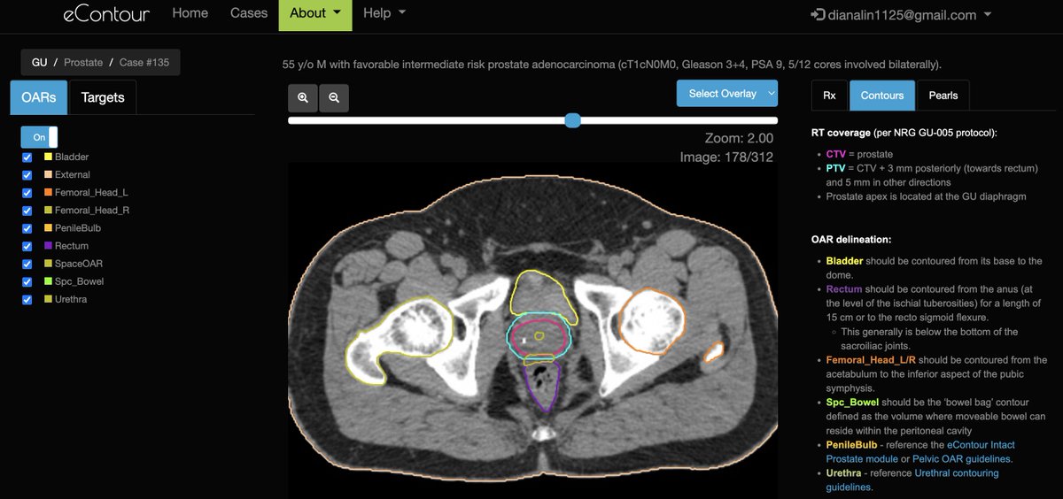eContourRadOnc's tweet image. 🤔 Wondering when the next #eContour case will be out? Wait no more!

🚨 We have a fresh new prostate SBRT case courtesy of    ⭐️ #radonc resident Leonid Reshko from @uofcincy!

✅ it out here: econtour.org/cases/135

@ARRO_org #MedEd