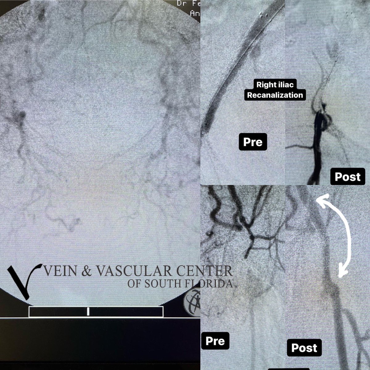 GotVeins's tweet photo. Complicated case of a middle aged female smoker with gangrene and rest pain both feet. Bilateral iliac and femoral occlusions treated with minimally invasive techniques today! #pvd #vasculardisease #smoking #vascularsurgery #endovascularsurgery #woundcare #gangrene #angioplasty https://t.co/iYOWhtS0Th