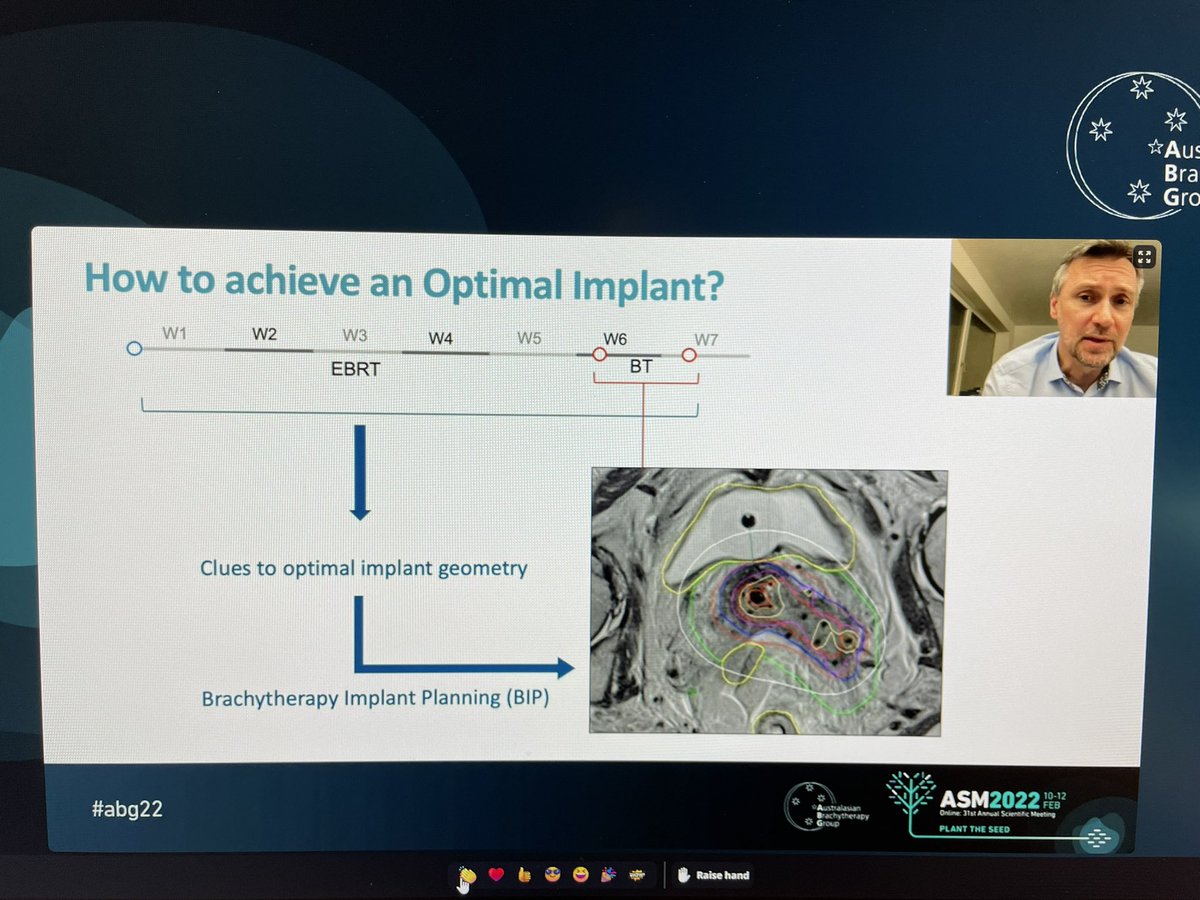 CarminiaLapuz's tweet photo. Fascinating talk by @petric_primoz discussing #MR pre-planning for optimal gyn #brachy implant and #3Dprinting applications - innovations session #ABG22. @ausbrachy #gyncsm @sylviahanna18 @adelinelim @sylvia_vandyk https://t.co/X9SVnOJUbd