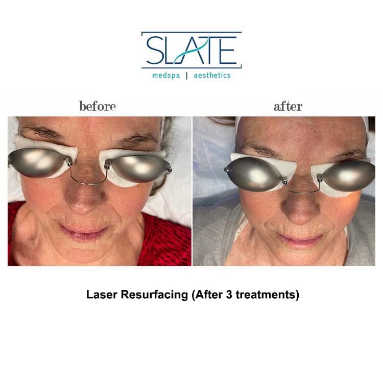 slatemedspa's tweet photo. WOW!!😱 Here are before and afters of one of our clients who was amazed by her results.
Benefits:
✨Minimizes sun damage, acne scars &amp; fine lines.
✨Improves skin texture and evens skin tone.

Call ☎️ 877.588.4646
Text 📱 201.889.2222
Web 💻 https://t.co/fNK6oDz0Dy
- https://t.co/WuS95lF4L2