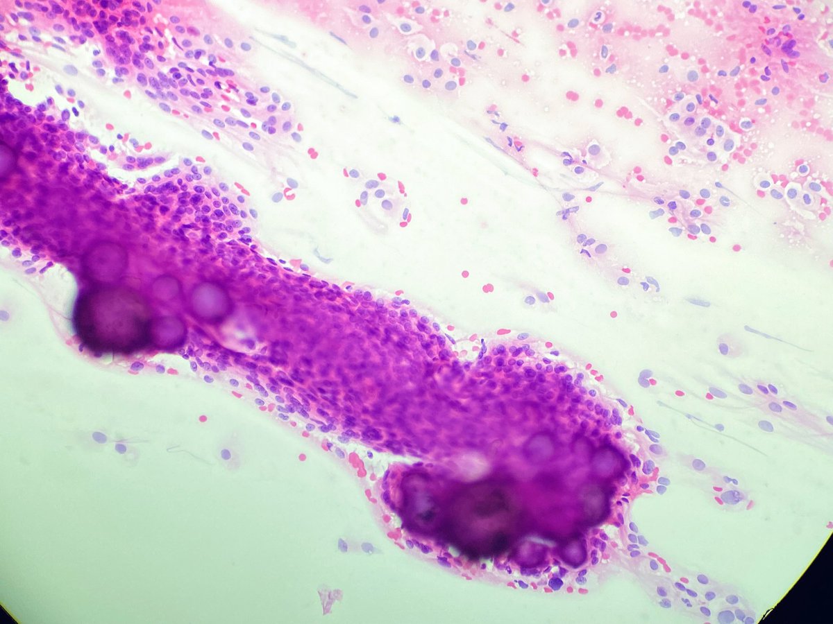 NRiddleMD's tweet photo. Different focuses. #Intraop #Neuropath #Meningioma https://t.co/IDHfEKjGfW