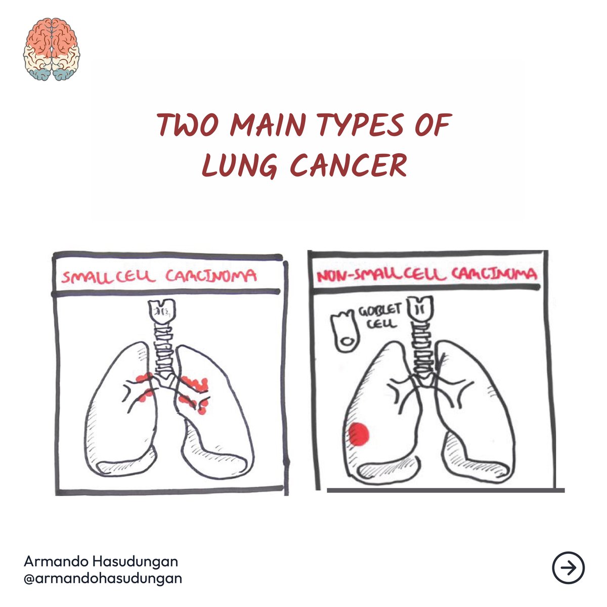 armandohasudung's tweet photo. Lung cancer is classified into small cell carcinoma & non-small cell carcinoma based on the microscopic appearance.
Read more @
https://t.co/zIWDcty283
https://t.co/URFtDeQ2oj
#lungcancer #oncology #lungdisease #chemotherapy #radiotherapy #lungs #oversmoking #secondhandsmoking https://t.co/K9zH3m9sjq