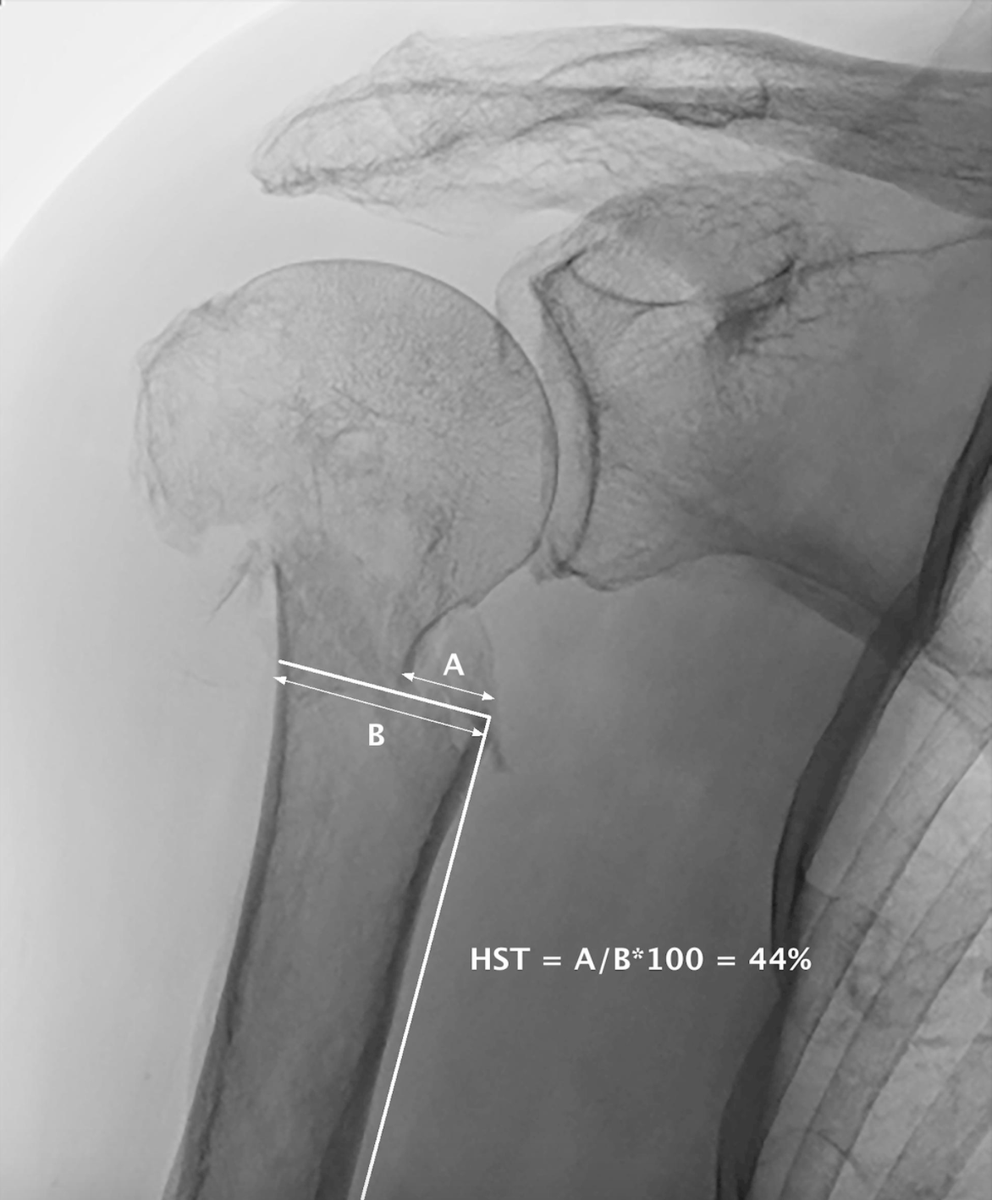jbjs's tweet photo. Prediction of #Nonunion After #Nonoperative Treatment of a Proximal Humeral Fracture - ABOS WLA Learning Source @EdinburghClinic #humeralfracture #shoulder
https://t.co/UOQ3pfHJ8b https://t.co/vplBacFVfN