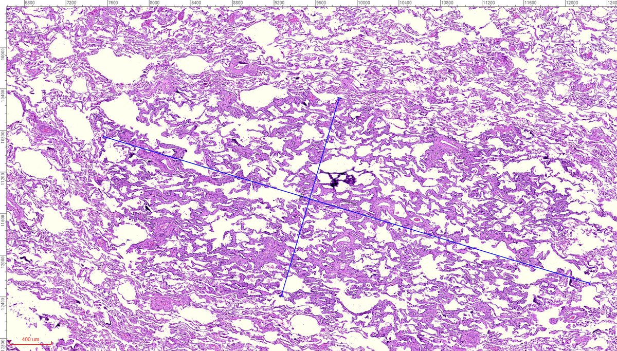 fabiotavora's tweet image. One of the consequences of #covid19 was an exponential increase in thoracic imaging. For #pulmonarypath, the results are more biopsies for incidental ground glass nodules. Several articles will come out from this phenomenon, I guess. 40yo patient, tough frozen. @smlungpathguy
