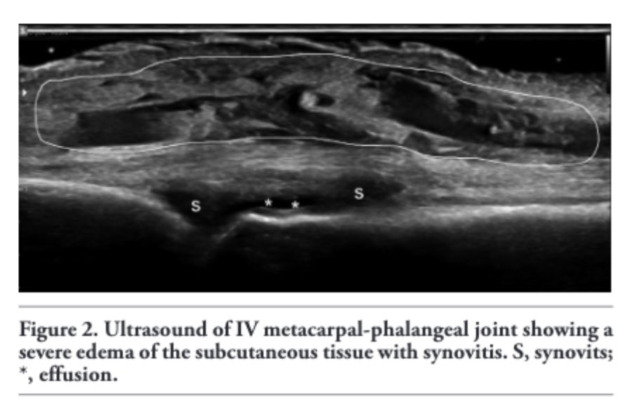BeyondRheumatol's tweet photo. Case Report. 📋🩺
An 84-year-old woman presented at the outpatient clinic of our hospital for acute swelling and pain of the hands and wrists in the previous 5 days…… https://t.co/9zWwnPkqcw #RS3PE #ultrasound https://t.co/KZ3KTXJwke