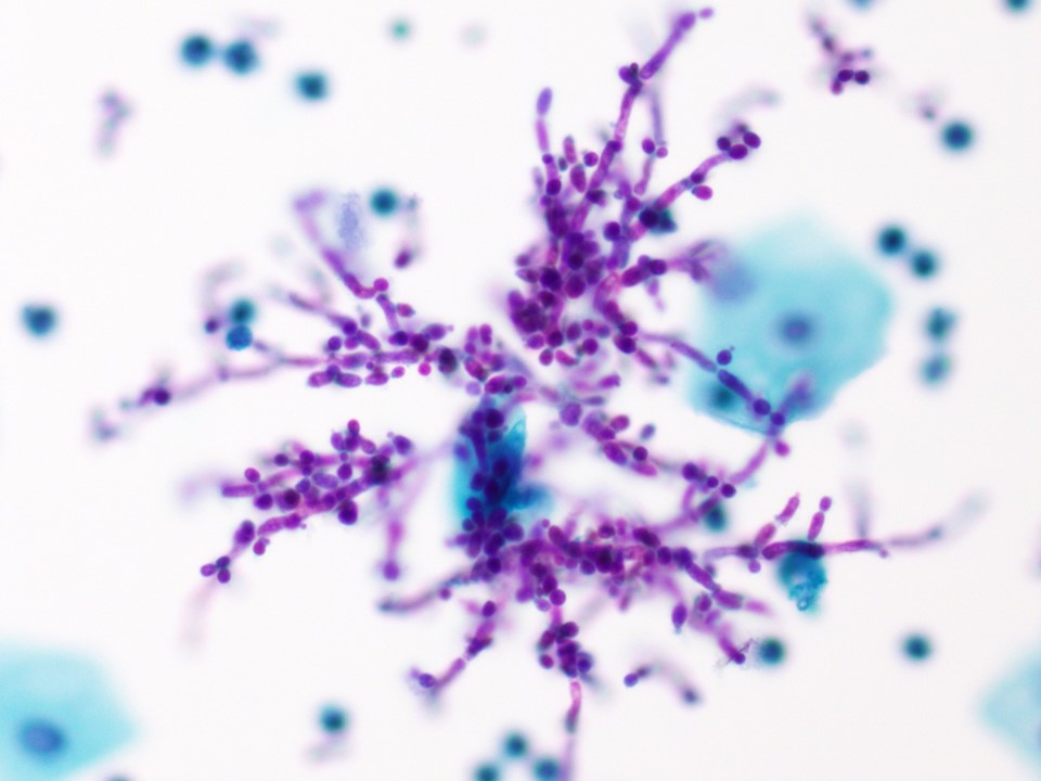 VandaTorousMD's tweet photo. #FluidsFriday Urine sample with Candida #Cytopath #PathTwitter https://t.co/E8VExAYG0d