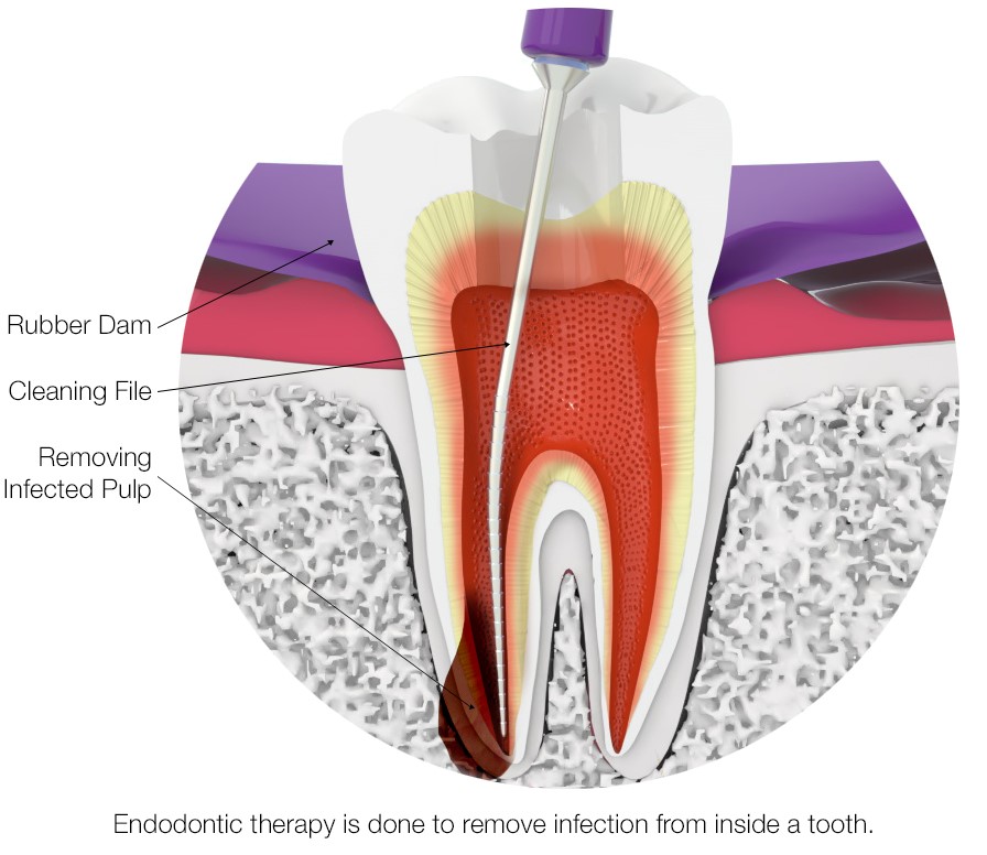 archerdentalca's tweet photo. Snazzy new custom graphics help Archer Dental discuss recent breakthroughs in #rootcanaltherapy and related endodontic procedures on our blog, https://t.co/P6EzPWJEBm https://t.co/XMz9g6Cso1