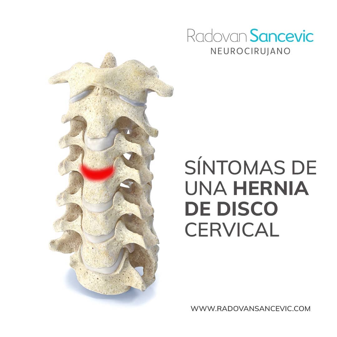 RadovanSancevic's tweet photo. Síntomas de una hernia de disco cervical
Una hernia de disco en el cuello puede causar una variedad de síntomas en el cuello, los brazos, las manos y los dedos, además de algunas partes de los hombros. https://t.co/zvMIjNoyAW