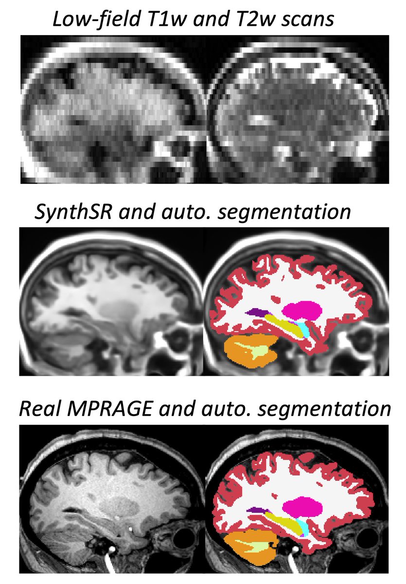 New preprint on the application of SynthSR to portable MRI (Hyperfine) scans. High correlations with many ROI volumes derived from matching high-field 1mm T1s!
arxiv.org/abs/2202.03564
SynthSR is available in <a href="/FreeSurferMRI/">FreeSurfer</a>.
With <a href="/RosenLab/">Matt Rosen</a> <a href="/rianaschleicher/">Riana Schleicher</a> <a href="/sheth_kevin/">Kevin Sheth</a> <a href="/wtkimberly/">W. Taylor Kimberly</a>