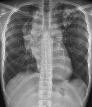 MayoPCCM's tweet photo. CXR with bilateral pulmonary #opacities with possible #cavitation.
🤔 What is your next step? https://t.co/npVqliNat9