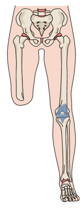 ArthroToday's tweet photo. There are higher overall complications and longer LOS among #TKAs patients with prior contralateral #AKAs. @womenAAHKS @DrAntoniaChen @JanetConwayy @djschuett @jointdocShields @BoneDocMMD 

https://t.co/UbGL6VmeUZ https://t.co/cSEPbuepxc