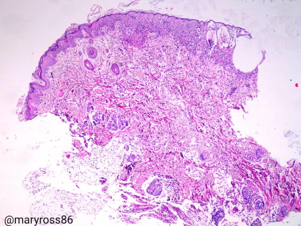 Maryross86's tweet image. Interesting Case: newborn female with generalized bullous lesions. Maternal history: newborn male died for "bullous lesions".  @martiponi @mreyesm  @SocPediPath @MarcelaSaebL @luishcruzc @kriyer68 @Alipathy @TheKarenPinto @mydermpath #dermpath #dermatology #Pedipath #pathology.