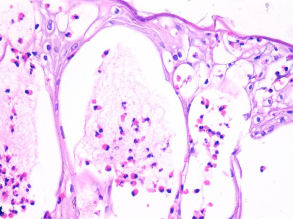 Interesting Case: newborn female with generalized bullous lesions. Maternal history: newborn male died for "bullous lesions".  <a href="/martiponi/">Marta Garrido Pontnou</a> <a href="/mreyesm/">Miguel Reyes-Múgica</a>  <a href="/SocPediPath/">Soc. Pediatric Path.</a> <a href="/MarcelaSaebL/">Marcelasaeblima.</a> <a href="/luishcruzc/">Luis Humberto Cruz C</a> <a href="/kriyer68/">Kalyani Bambal</a> <a href="/Alipathy/">Alicia Núñez Abreu, MD🔬🇩🇴</a> <a href="/TheKarenPinto/">Karen Pinto DNB, FRCPath</a> <a href="/mydermpath/">Raj Singh MD</a> #dermpath #dermatology #Pedipath #pathology.