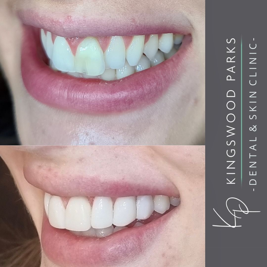 KPClinics's tweet photo. 8 x Composite Veneers used to create this beautiful transformation #dentist #compositebonding #veneers #hull #veneershull #hullcity https://t.co/eX9CPMSTZ4