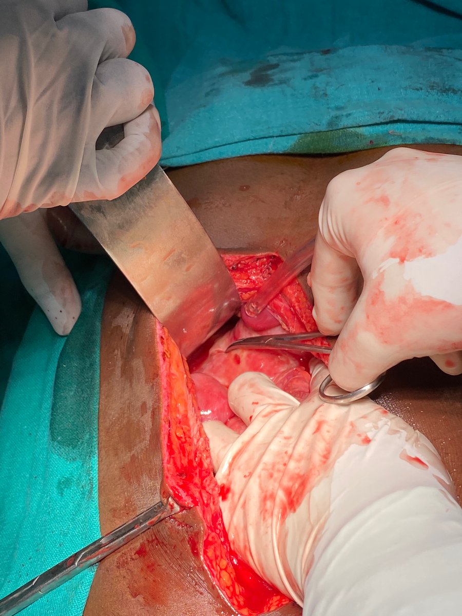 Drradheshyam31's tweet photo. First as #primarysurgeon say no to #NSAIDS #notonsaids https://t.co/4Atry8dhVY