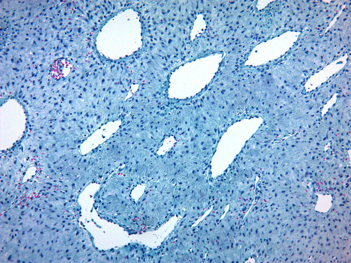 luishcruzc's tweet photo. Nasopharyngeal angiofibroma-
"Lining endothelium appear to be resting directly on the connective tissue stroma"
#Pathology #ENTPath #PediPath #BluePath #NejibStain https://t.co/zWT3zXSFiA