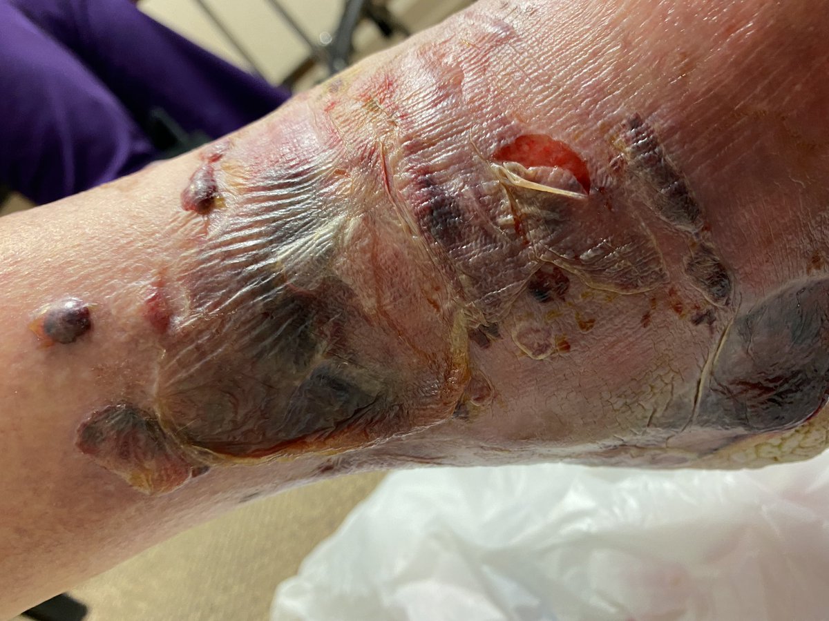 NathanGauseMD's tweet photo. Me: so if there are no other questions we’ll get ya all set up to get that ankle fixed later this week
**removes splint**
Me: yeah…um…about what I said a few minutes ago…I lied 🤥 https://t.co/Msi1LnEzxm