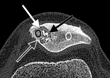 Dorsal Defect of the Patella: An Efficient, Safe, and Minimally Invasive Treatment with Percutaneous Sclerotherapy Using Radiopaque Gelified Ethanol ow.ly/o1iC50HL1Ea #irad