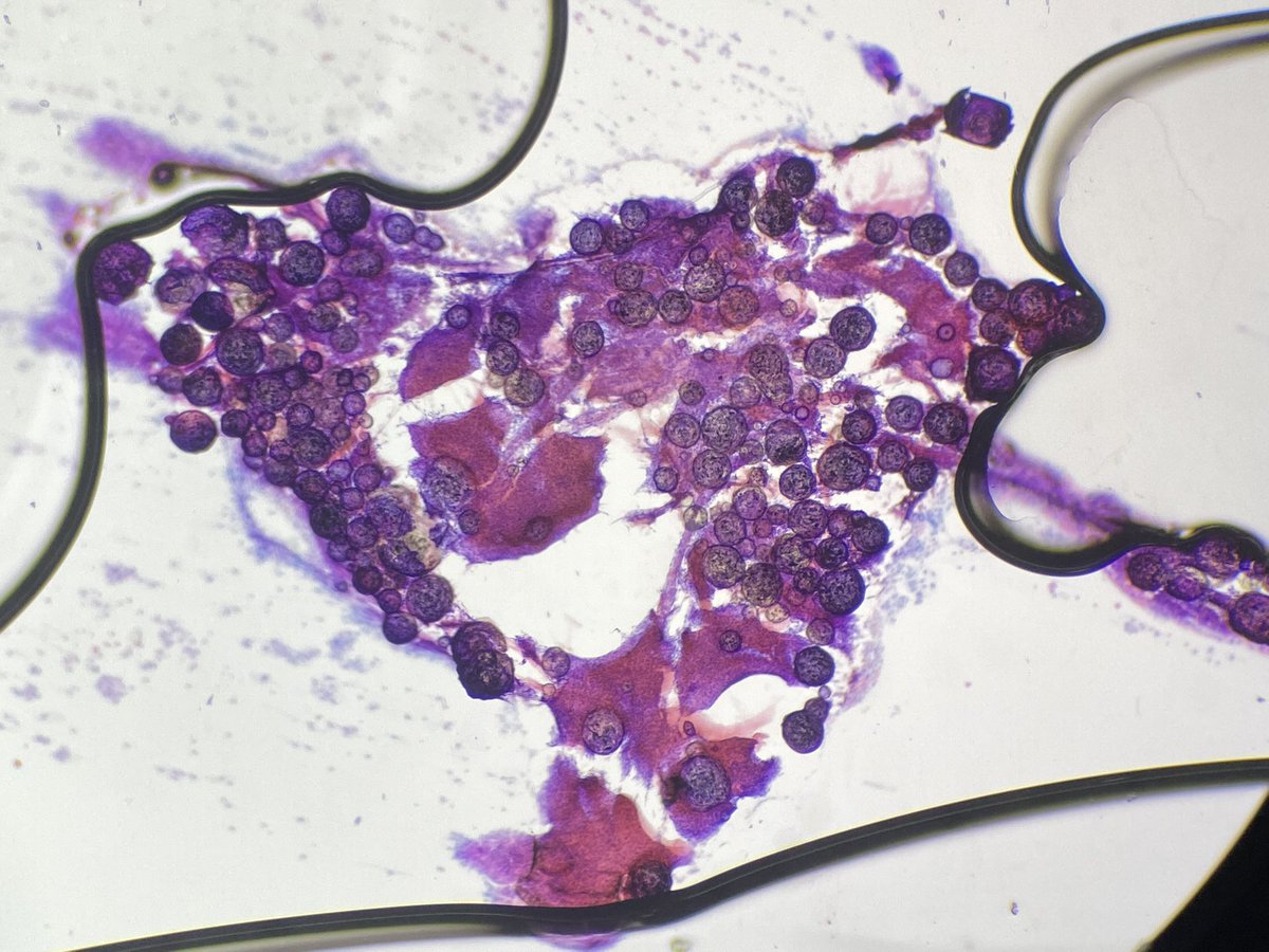NRiddleMD's tweet photo. The calcs made a bubble under the coverslip #Meningioma #NeuroPath  #Intraop https://t.co/eBnGDTW00a