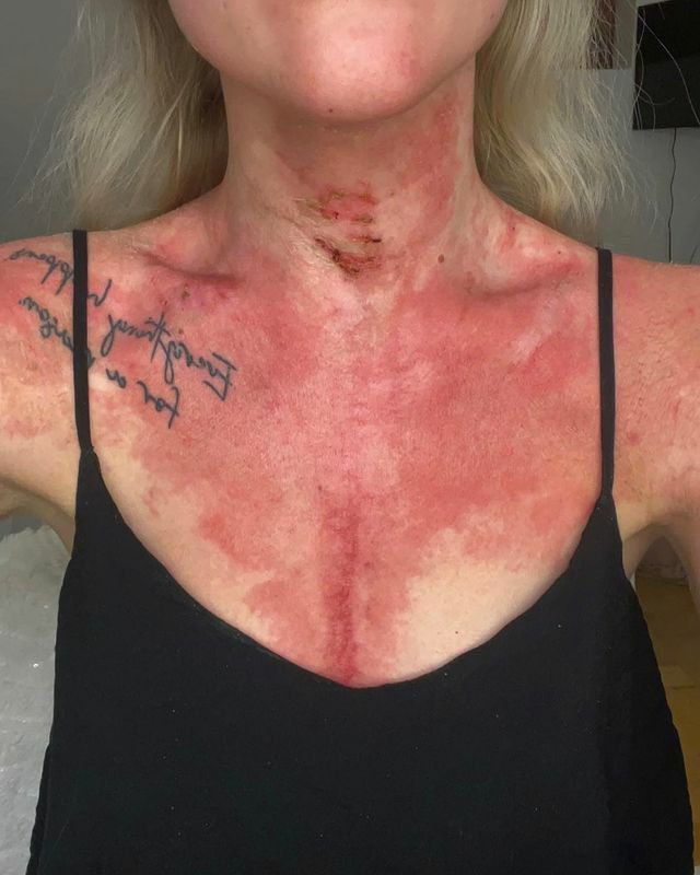 girliwhirl3's tweet photo. After my second covid injection I took in August, I have struggled with constant skin rashes on my body. Last Sunday I had to go to the emergency room and spend the whole day there, the pain simply took over. It's time to stop silencing side effects.

Join ➣ @The_StormQ17 https://t.co/MROsVQoBKB