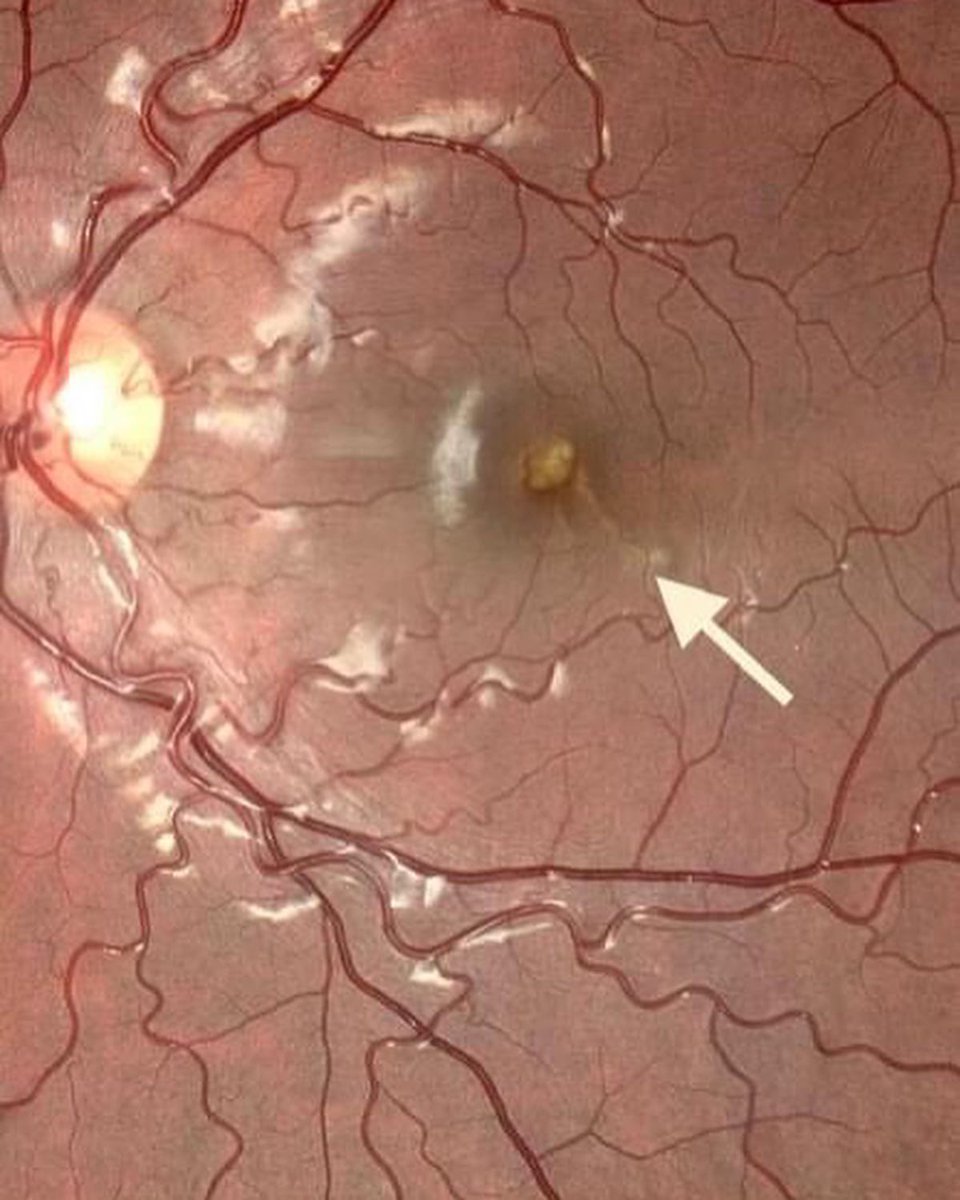 oftalmoavanzada's tweet photo. Los señaladores LASER NO SON UN JUEGO!!!nunca dejar jugar a los niños con esto. 
Aquí un caso de lesion en la retina en un niño por mirarlo directamente!
COMPARTE! ↗️ https://t.co/5asGqH3EZx