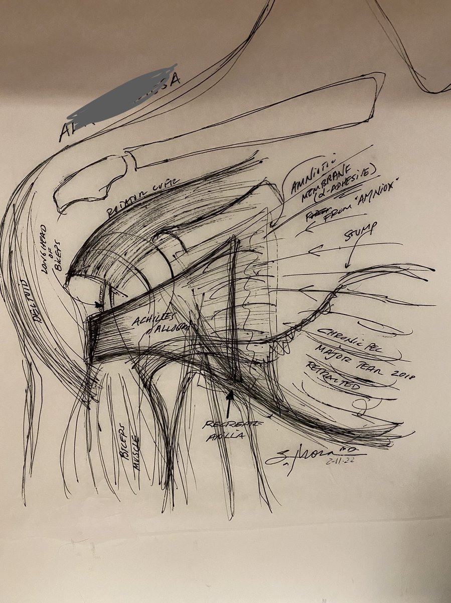 myorthodoc's tweet photo. It you can draw it you can reconstruct it- My Chronic Pectoralis Major Tear Reconstruction sketch, aka ThePecFlexFix ! You don’t need to live with a chest wall deformity. #orthotwitter #moramd #orangecounty #orthopedicsurgery #benchpress #powerlifting https://t.co/ycZf2aWork
