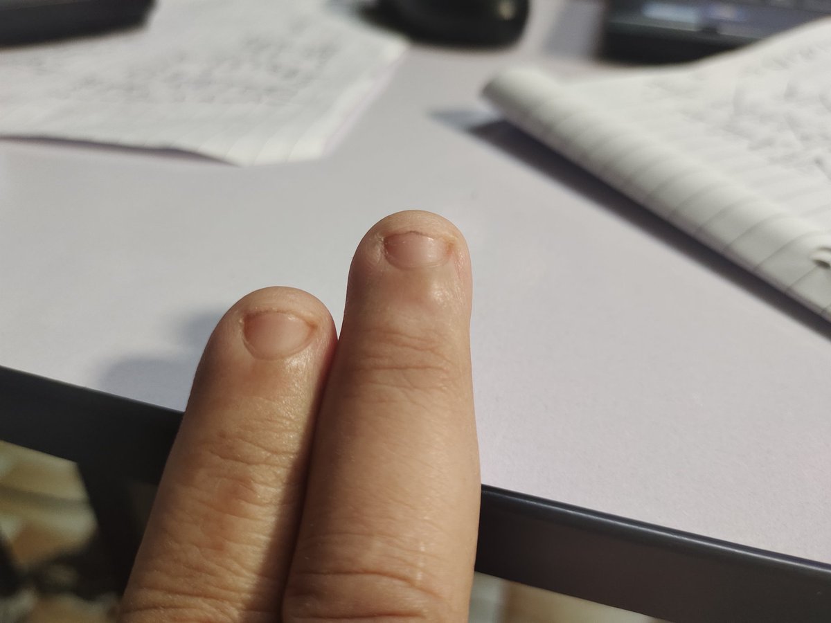 chanteq73's tweet photo. Looking for small finger nail
We might be have same DNA.
From our great-great grand parent
Because it rare. 
May be we are cousin..🥰

#smallfingernail #samefamily #maybewearecousin 

Ok bai https://t.co/SJkhOzM2jF