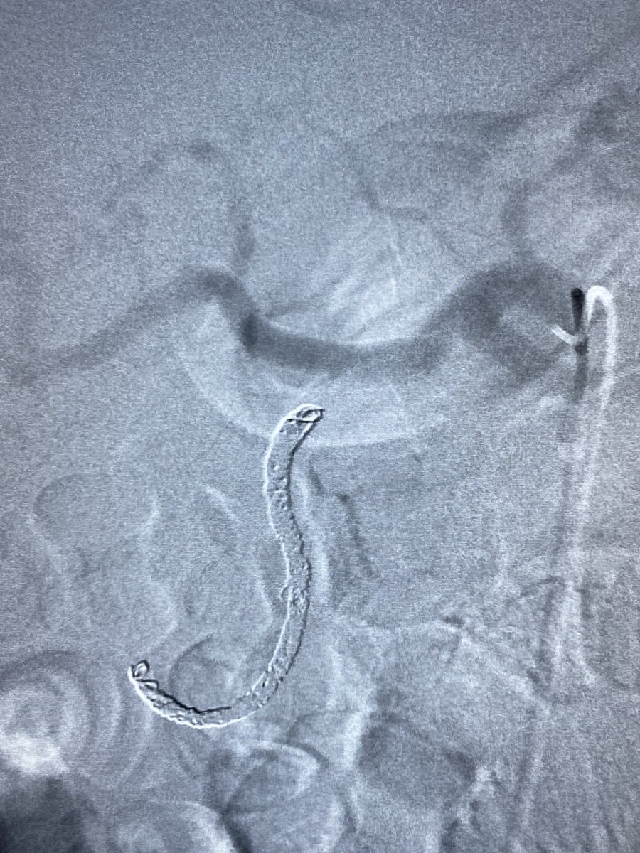 IR_Cain's tweet photo. Very few things more rewarding in medicine than seeing a crashing patient stabilize while still on the table…80s systolic on pressors at the start of the case; 130s systolic off pressors at the end of the case. #IR #wecanembothat #irad https://t.co/Sz011Pwful