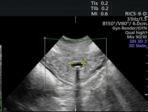 CEOGjournal's tweet photo. Welcome to read Volume 48Issue 6
Comparison of different uterine incision closure methods used in #cesarean_section in terms of postoperative cesarean incision scar thickness and isthmocele formation: a prospective, randomized study
#Isthmocele
https://t.co/yu1xeuhscW https://t.co/JlaINSPiBU