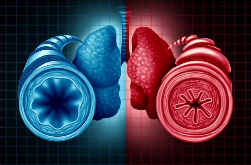 irisnancy97's tweet photo. How Often Do Adults With Severe Asthma Switch or Discontinue Biologics? https://t.co/EjSfmAkcWo 
#SaturdayMorning #Laryngology #otology #rhinology https://t.co/ui0O3amf4K