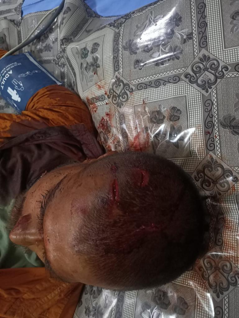 swati_gs's tweet photo. Ravi, a youth from Noida, was attacked by swords yesterday, by a mob that didn’t like him putting up a Whatsapp status that he had voted for @myogiadityanath. Just look at the wounds

Ravi is a member of @agniveer and a gau-sewak. Another youth Pawan was also assaulted https://t.co/xXwNrksUpW