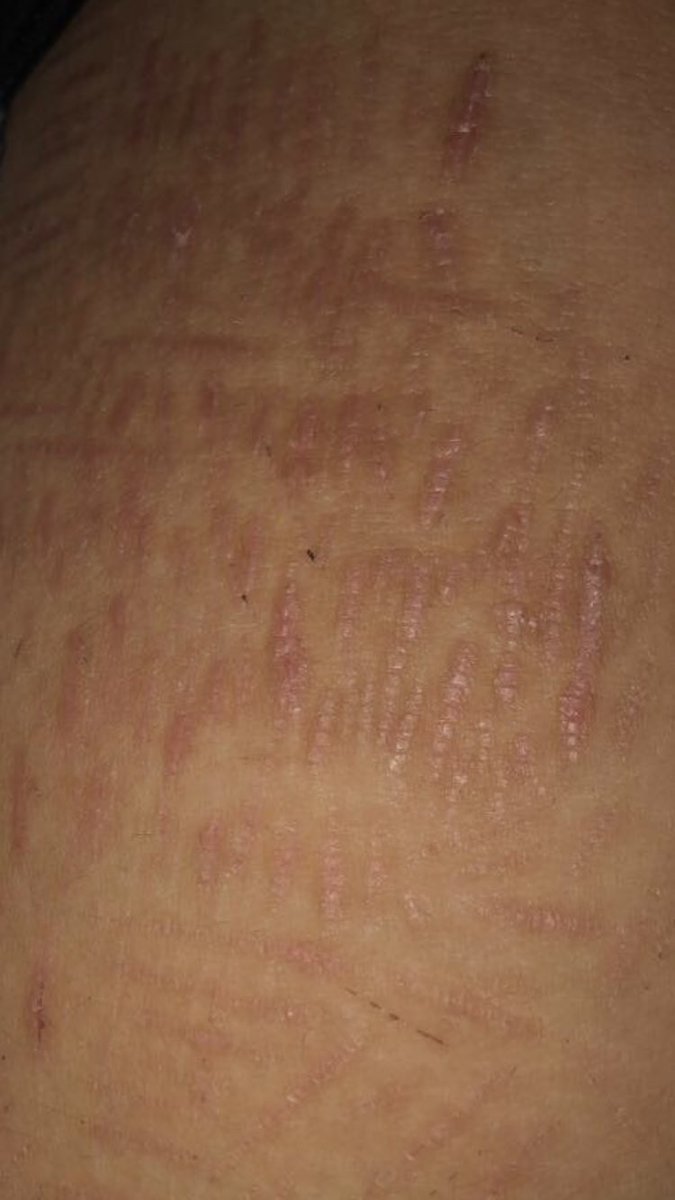 broisnowdude's tweet photo. #shtwt
Scars started to fade😍 https://t.co/knbDVVKUIj