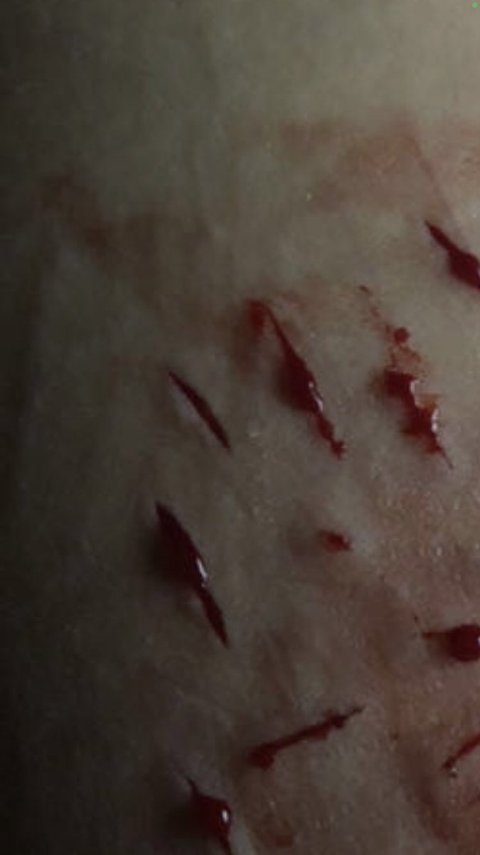 broisnowdude's tweet photo. #shtwt
Scars started to fade😍 https://t.co/knbDVVKUIj