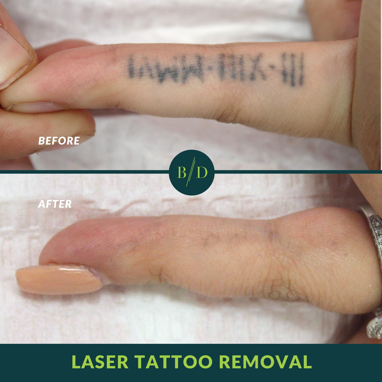 GO Tattoo Removal  Huge piece with HUGE progress after 5 treatments 