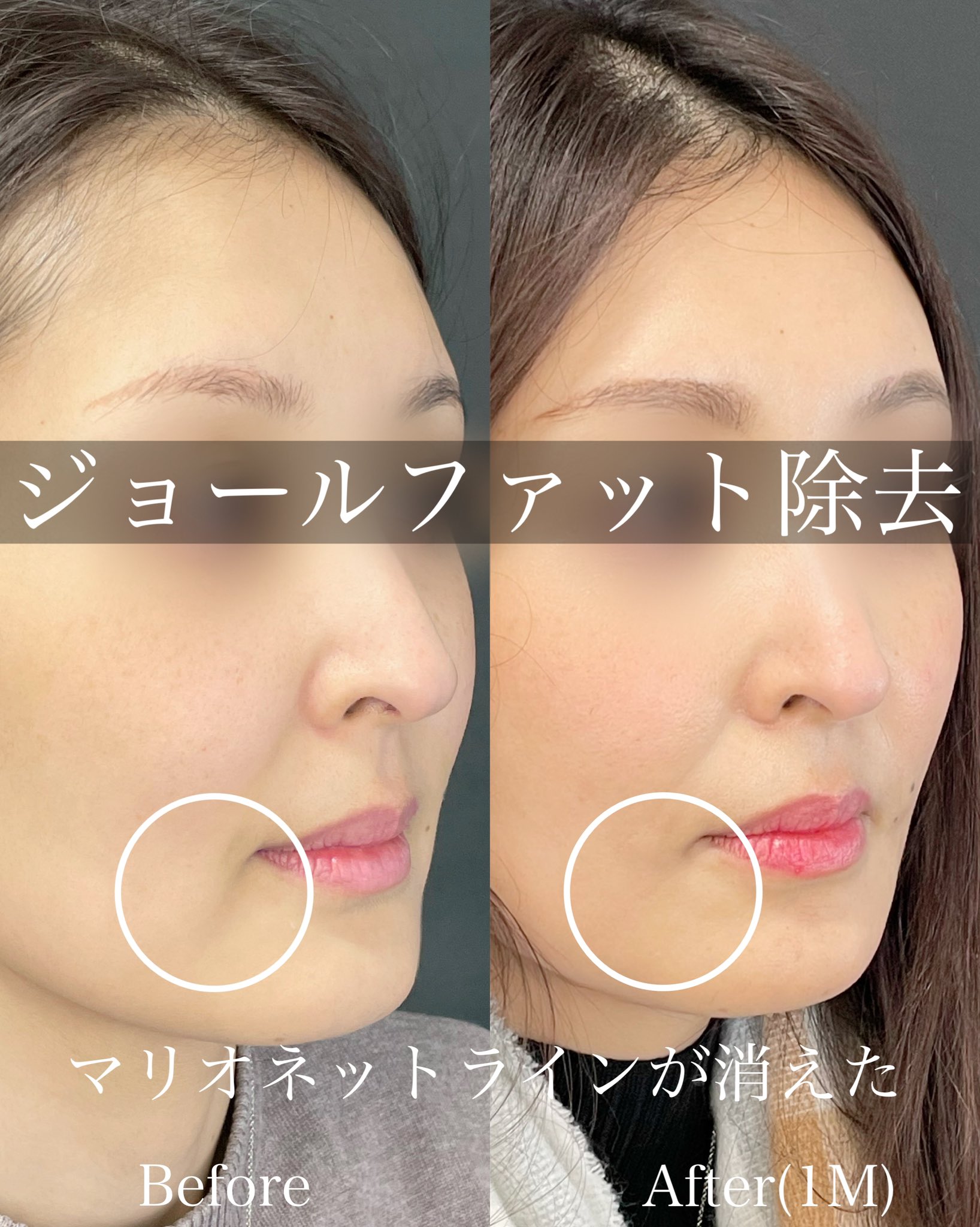 埋没 小顔脂肪吸引 くまとり 大阪 平田一記 ルラ大阪院院長 ジョールファット除去のモニター様です 1ヶ月後なのでまだ拘縮がありますが 今後さらに馴染んでいくことでしょう ジョールファット マリオネットライン 脂肪吸引 ジョールファット除去