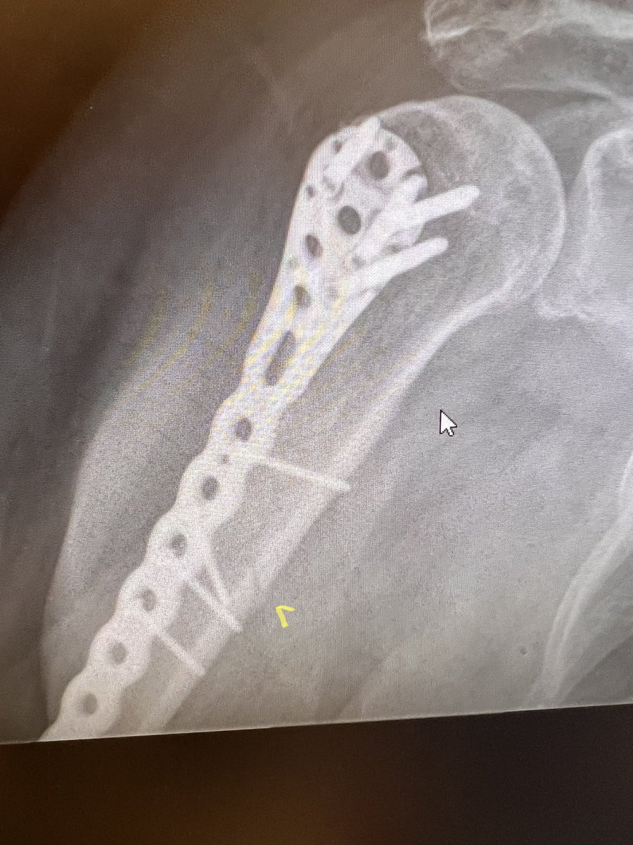 miucinMD's tweet photo. @TSevert @rkh_md @alphabravo42 Fracture? https://t.co/X3A7catRDe