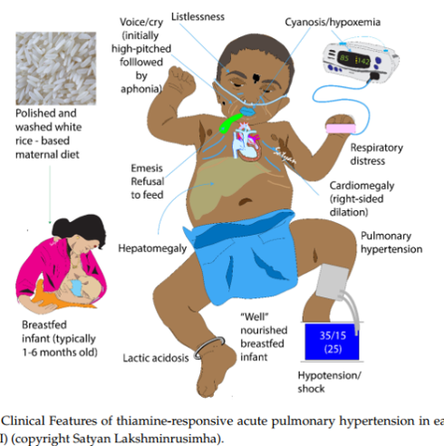 CardioCaribeMx's tweet photo. Una #rara causa de #HipertensiónPulmonar en los neonatos y lactantes: #déficit de #tiamina

El cuerpo no sintetiza tiamina, dependemos de la ingesta
Vida media: 10 días 
Predisposición a cursar con déficit si no se ingieren suficiente

DOI: 10.3390/children7110199
#HAP #tiamine https://t.co/1HOjpNw82O