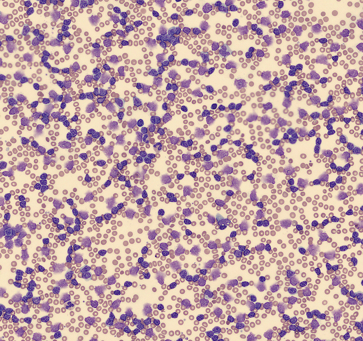 mer_501's tweet photo. Paciente con Hiperleucocitosis?
El Dr. Eduardo García nos contará como actuar en la 2º edición de #HematoBites Jornadas de urgencias hematológicas para residentes (y adjuntos!)
@HematoLaPaz
24/2 16 hs
Link de acceso:https://t.co/aFEi2EBRhL https://t.co/SLxRgNfhBT