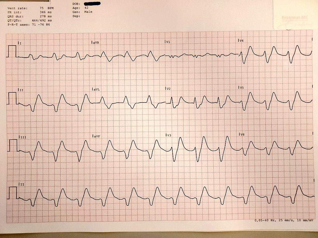 gerben_robbers's tweet photo. I love all the ECG stuff on Twitter. Today I got notice of this ECG. And, from a professional stance, it's a cool one; I could ask "what do you make of it?" and show how the ECG resolves. But not this time. Here's why:
#CardioTwitter #ECG https://t.co/4ogECMhHOu